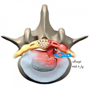 پارگی دیسک کمر