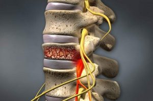 تنگی کانال نخاعی